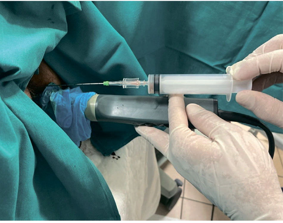 Пункционное дренирование абсцессов предстательной железы