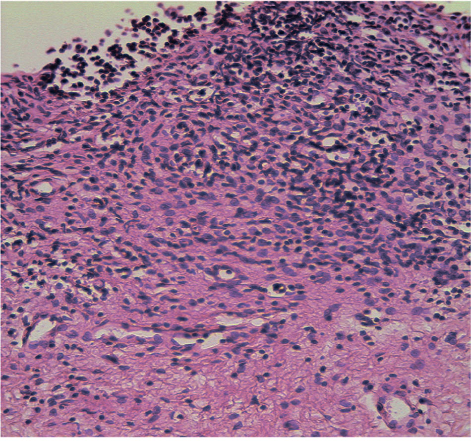 Слизистая оболочка на большем протяжении представлена 1-2 слоями клеток, большинство из которых слущены и свободно лежат над базальной мембраной