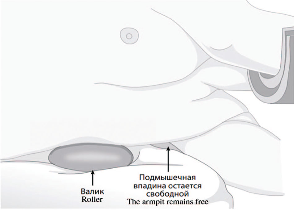 Правильное расположение подмышечного валика в положении больного лежа на боку [23]