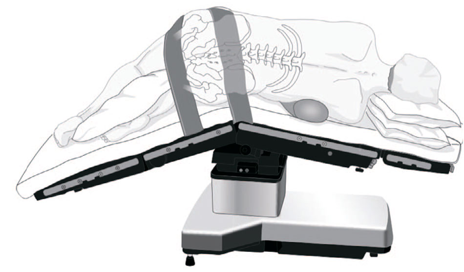 Положение лежа на боку с разгибанием операционного стола [23]
