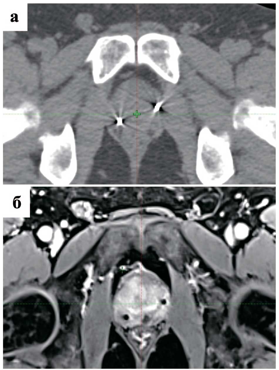 Рентгеноконтрастные маркеры в предстательной железе