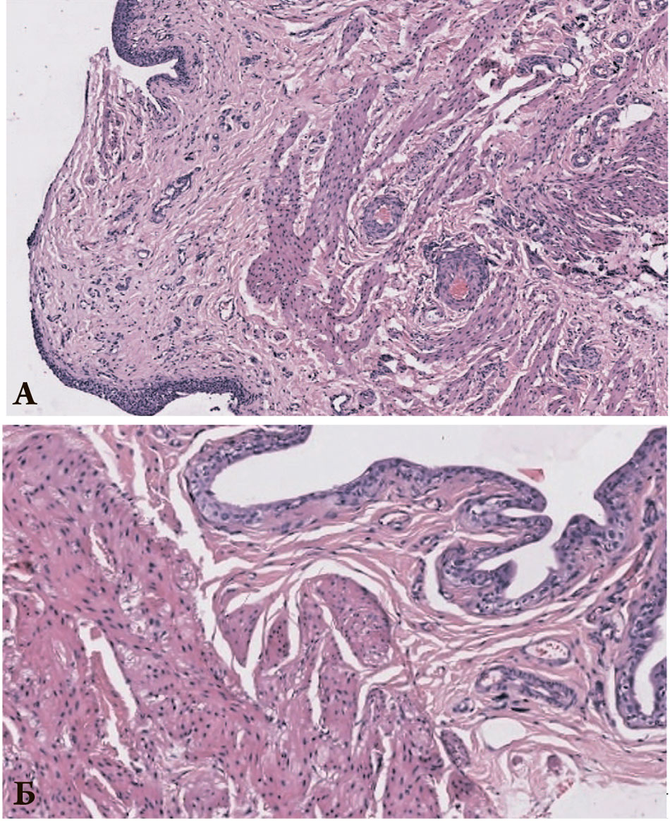 Гистологические изменения эпителия и подслизистого слоя мочевого пузыря