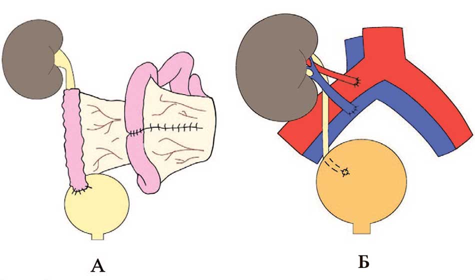 Реконструктивные операции при протяженных повреждениях мочеточника