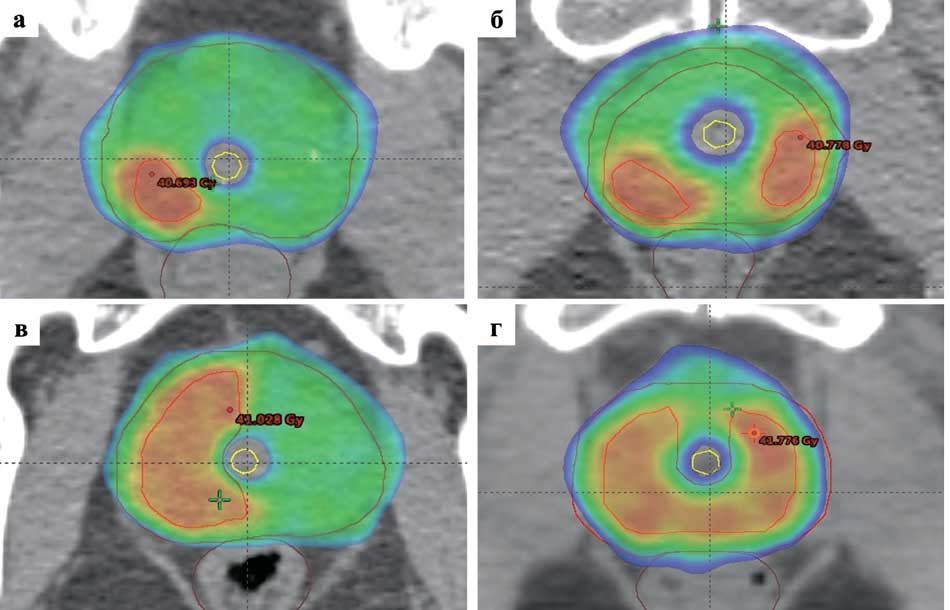 Изодозное распределение при различных вариантах уретросберегающей СТЛТ
